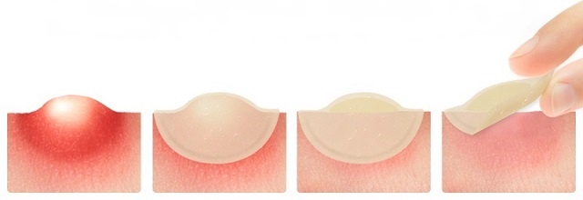 ELIZAVECCA-Witch-Piggy-Hell-Pore-Blemish-Spot-Patch-Anwendung